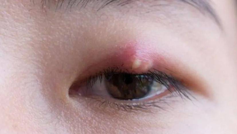 72眼睑皮肤局限性红,肿,热,痛,邻近球结膜水肿