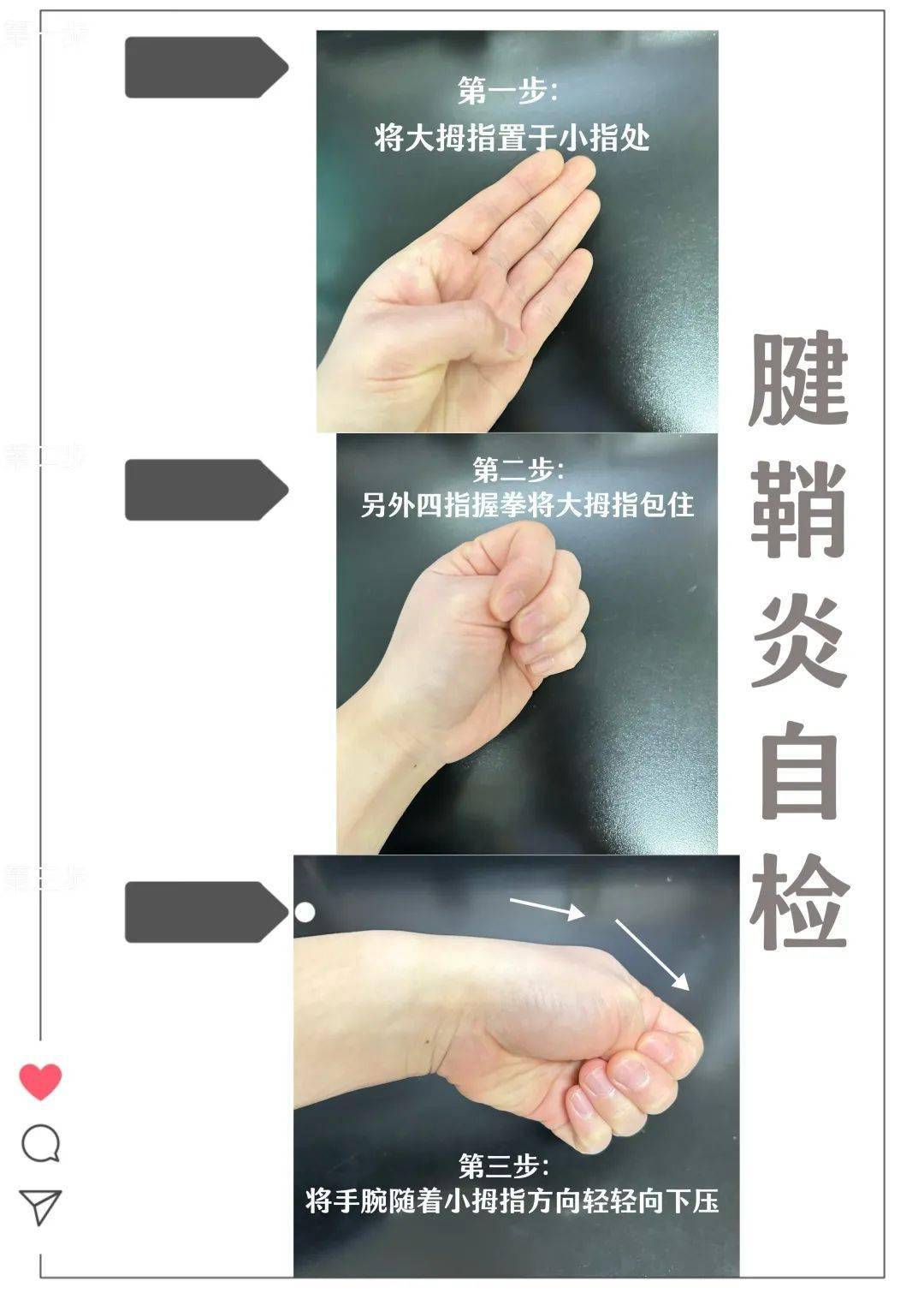 第二步:另外四指握拳将大拇指包住;第一步:将大拇指置于小指处;腱鞘炎