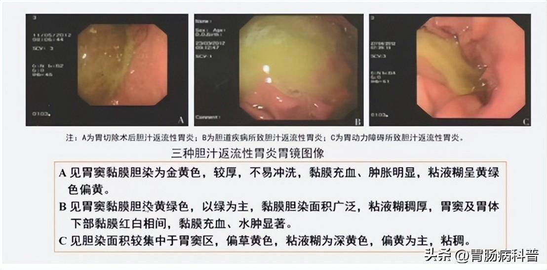 膽汁反流性胃炎的中醫治療_臨床_腹部_大便