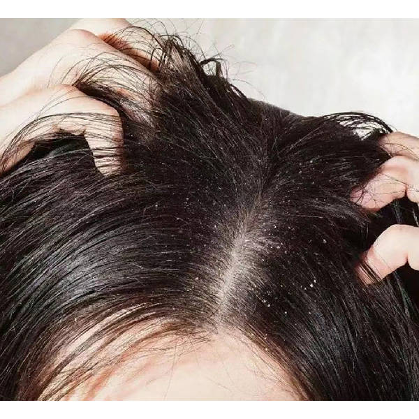 女生用什么洗发水去屑止痒?洗发膏去屑止痒去油推荐_头皮_问题_成分