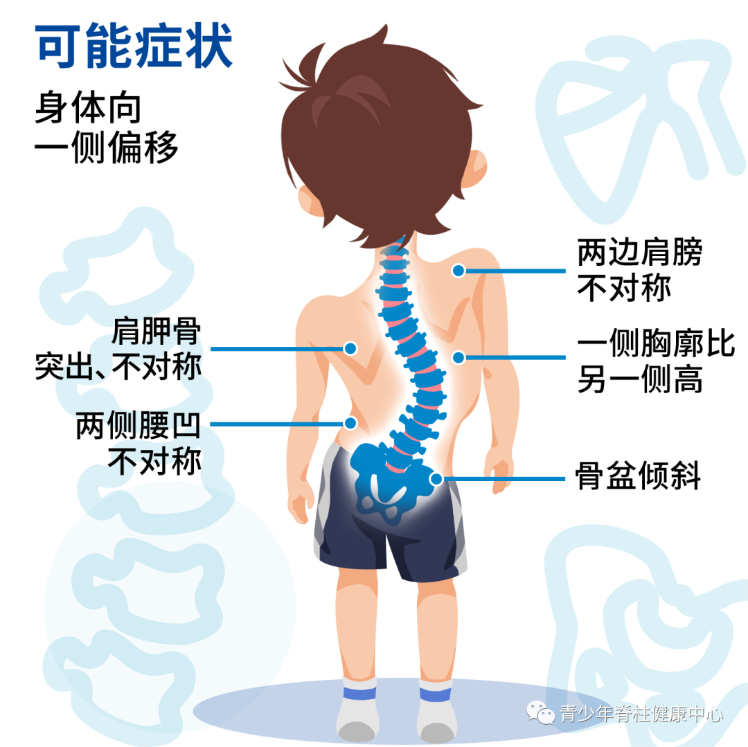 及时注意身体出现的脊柱侧弯可能症状哦以上这些小贴士可以帮助我们