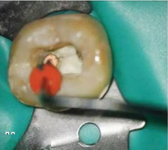 热牙胶充填术操作全图解_工作_加压_mm