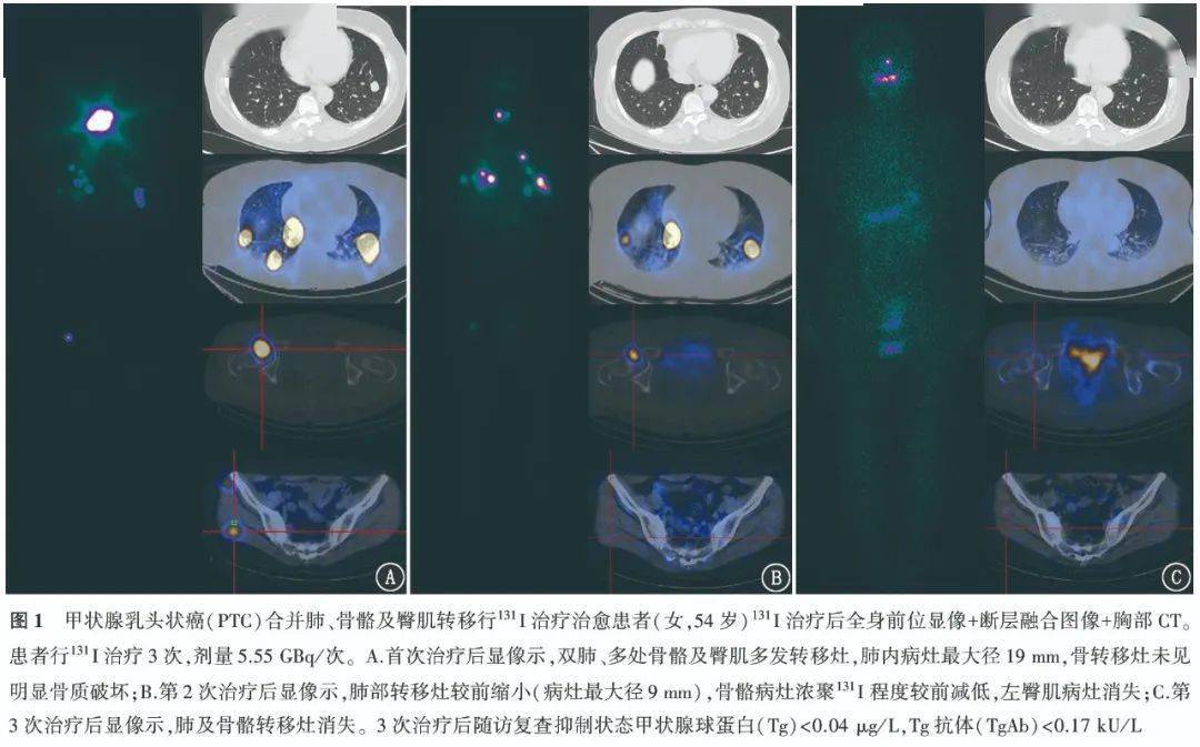 【学术】分化型甲状腺癌功能性远处转移灶的临床特征及131i治疗效果