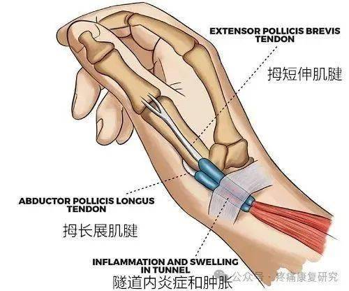 1.橈骨莖突狹窄性腱鞘炎三,手和手腕疼痛難治性