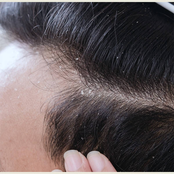 最好用的止痒洗发水