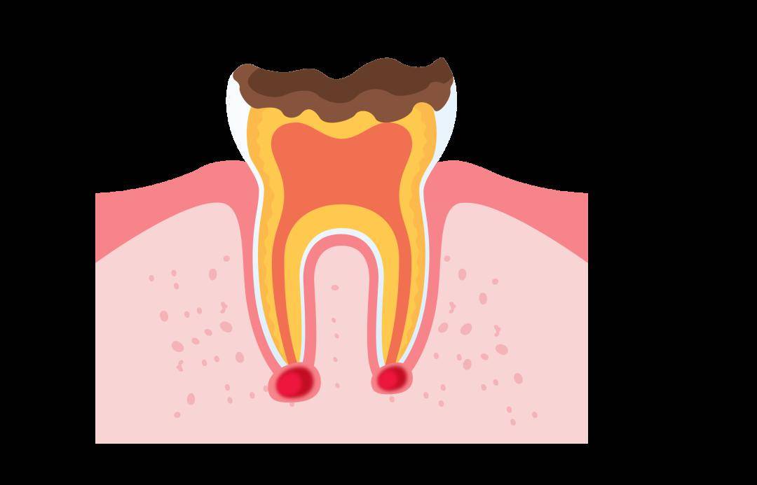 儿童乳牙的残冠,残根引发根尖周炎可能引起继承恒牙的牙釉质发育不全