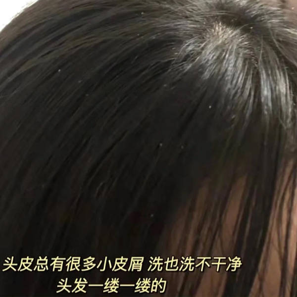 头发有大块头皮屑用什么洗发水?去屑控油止痒洗发水男_原因_油脂_产品