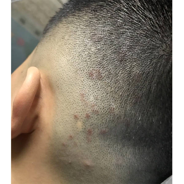 头皮屑小红疹等产生的原因:头皮屑的产生通常与多种因素有关.