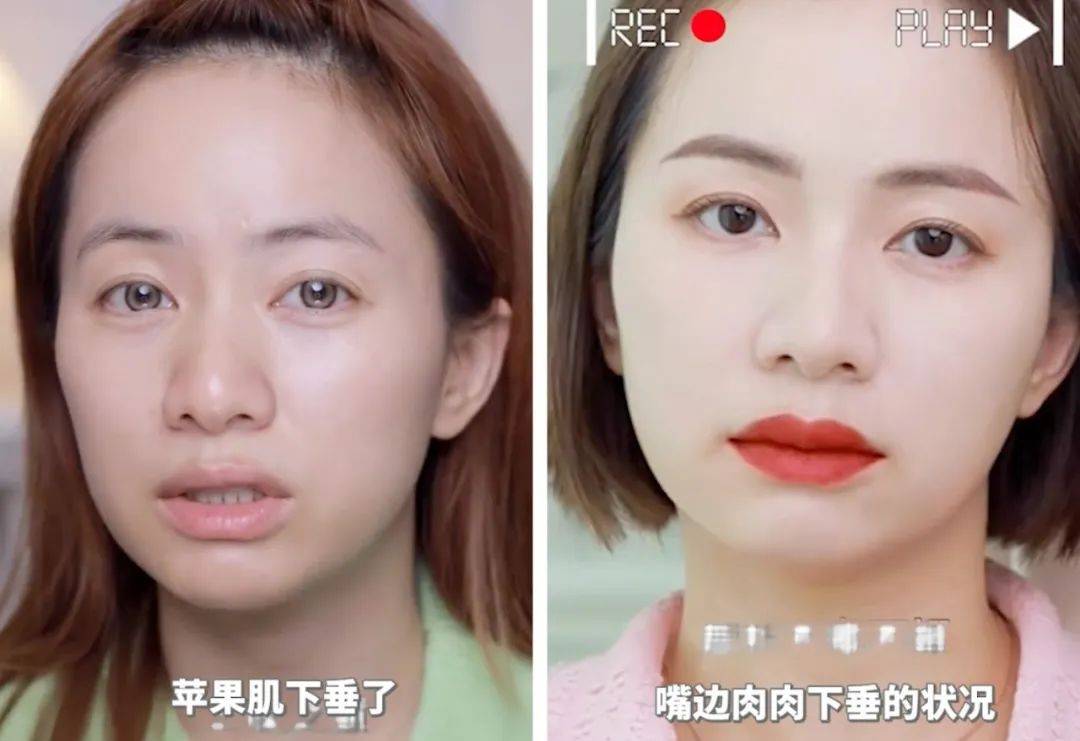 经历了生二胎后,我最大的面部改变就是眼窝凹陷,苹果肌下垂,再有原本