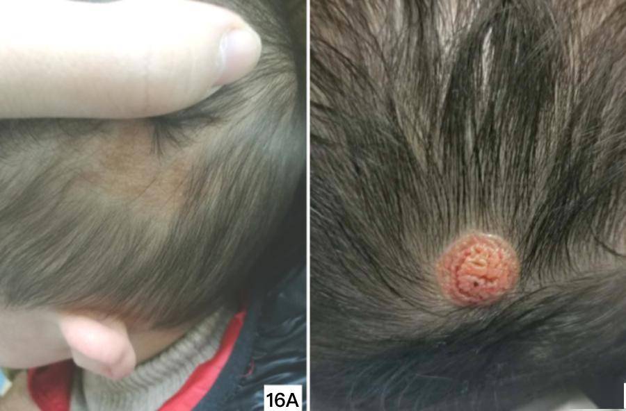 头部橙色斑块略高于皮面,表面蜡样光泽,表面呈颗粒状,沟回状17先天性