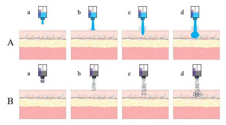 无针注射技术的研究进展_药物_针头_皮肤