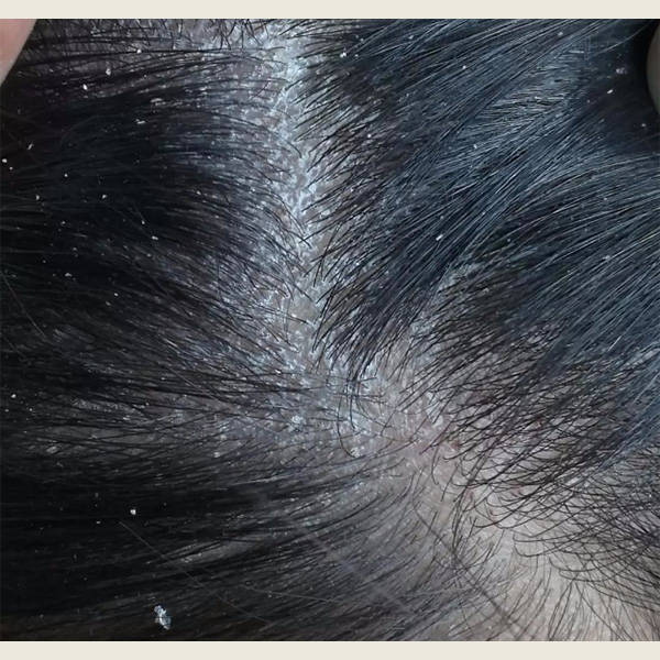 止痒控油洗发水推荐_头皮_头发_去屑