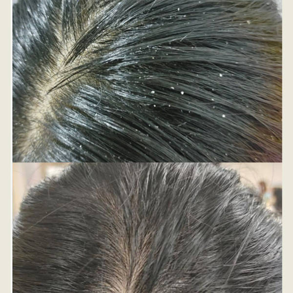 女生去屑止痒最好的洗发水排行榜_问题_头皮屑_生活