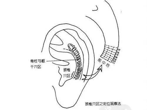 神奇的耳穴疗法,降压止痛治失眠