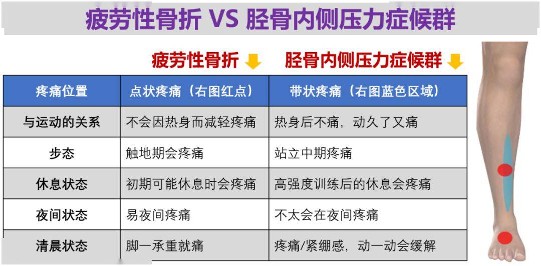 ②另一种是胫骨内侧压力症候群(medial tibial stress syndrome, mtss