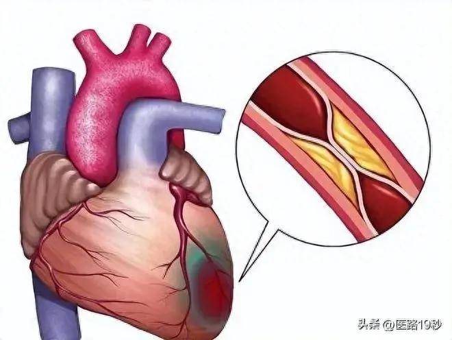 防治动脉粥样硬化的8大良药:守护心血管健康