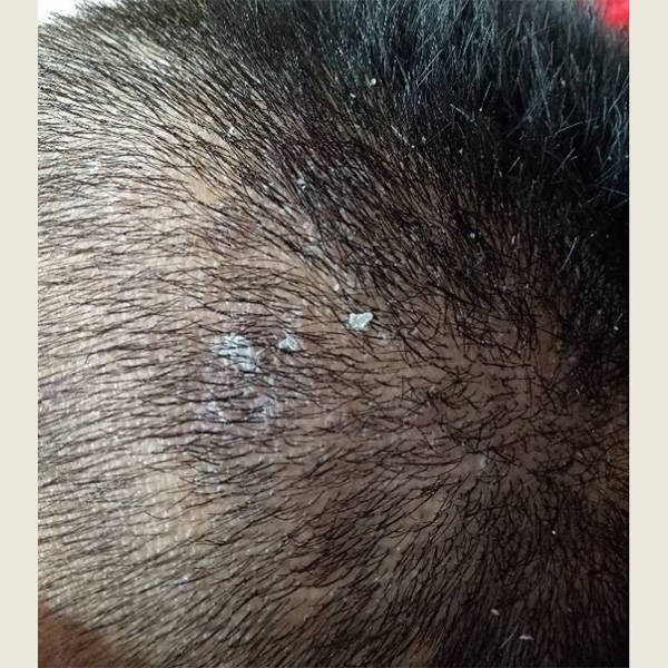 头皮屑毛囊炎等头皮问题产生的原因:头皮屑的产生通常与以下原因有关