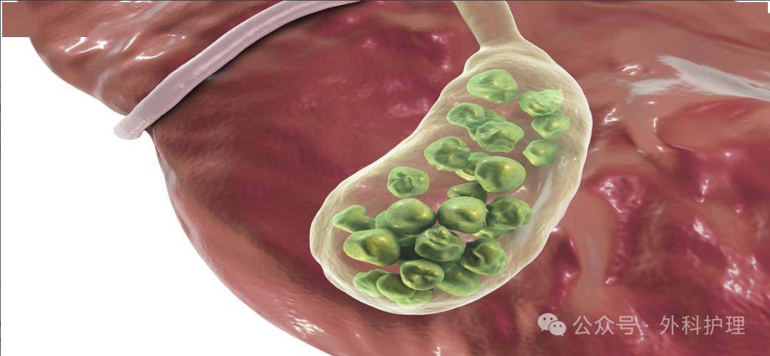 经综合检查后诊断为"胆囊结石伴胆囊炎"