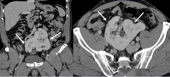 驼峰肾,马蹄肾,煎饼肾.肾脏结构异常 ct 图像,你都认识吗?