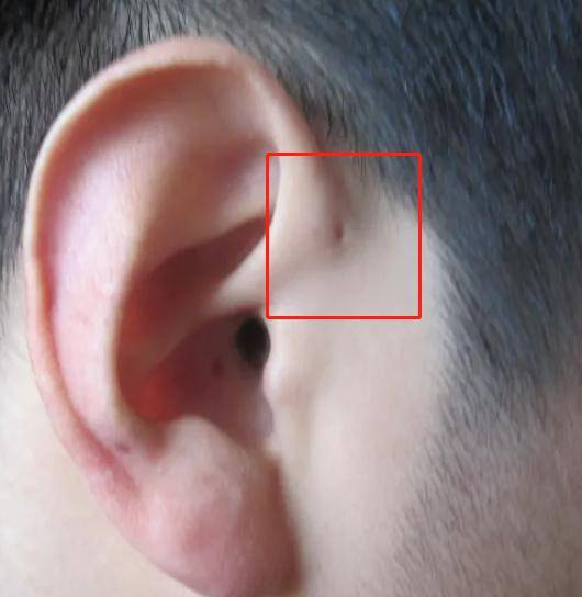 耳朵外耳廓中间凹进去图片