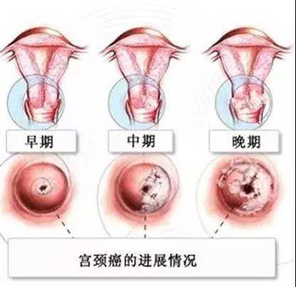 宫颈癌出现