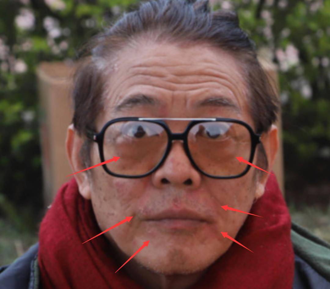 导致,而他的眼袋很重,眼周圈的皮肤更是松弛的明显,看着像80岁的老人