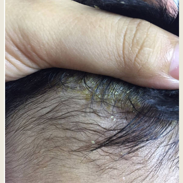 油性头发去头屑用什么洗发水好?什么去屑止痒效果较好_问题_头皮_感觉