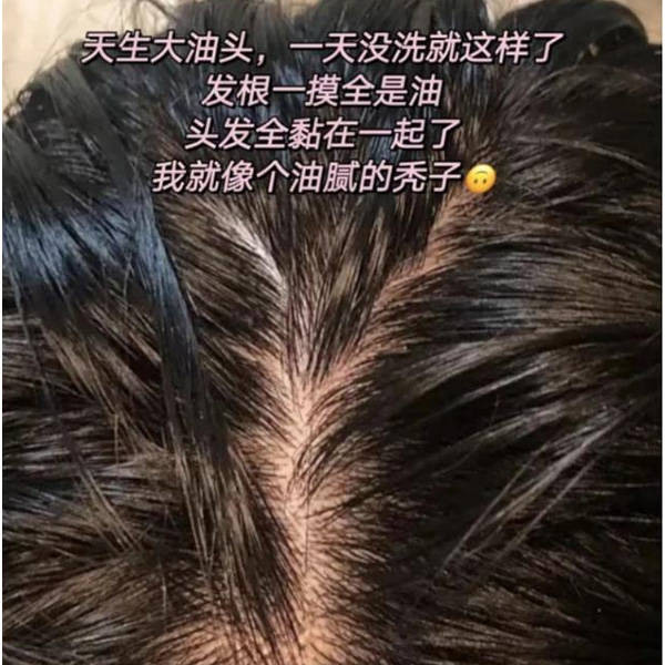 去头屑头痒的洗发水推荐_头皮_问题_头发