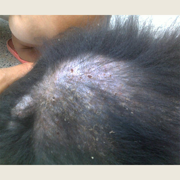 是一种由于皮脂腺分泌过多或皮肤对雄激素敏感性增加而引发的皮肤病