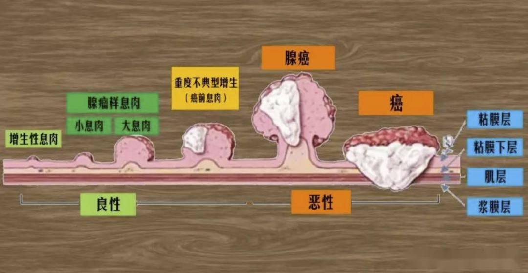 67息肉切了之后