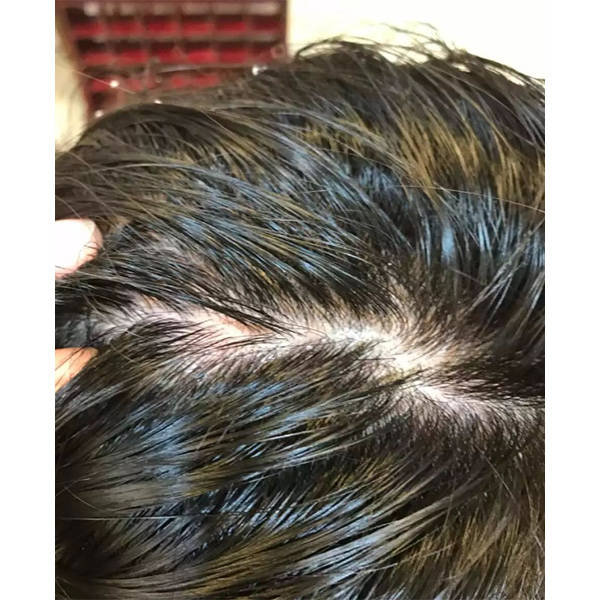 去屑_头发_头皮屑