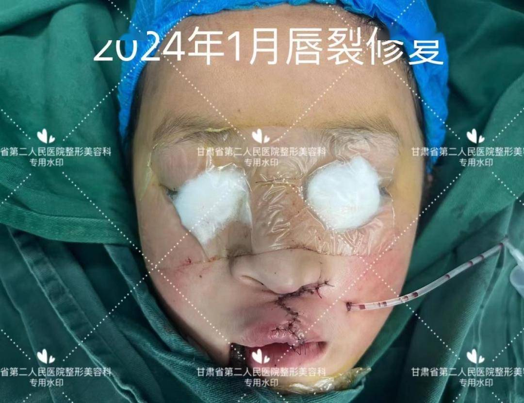 焕然"医"新丨省二院烧伤整形美容科为患儿成功修复唇腭裂