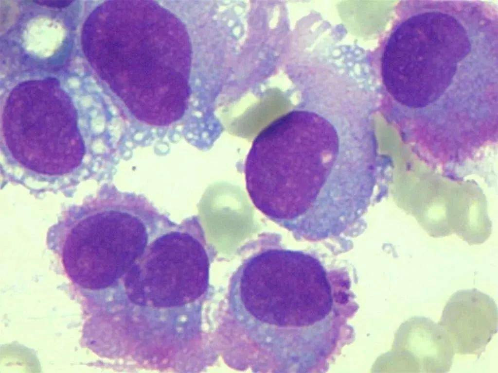 【病例分享】骨髓转移性恶性黑色素瘤_皮肤_临床_恶性肿瘤