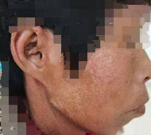 面具脸和椒盐征▲雷诺现象系统性硬化症(ssc)又称"硬皮病",其最显著