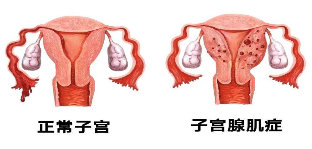 女科医话 | 痛经,月经失调,不孕,自然流产……可能是ta在作祟!