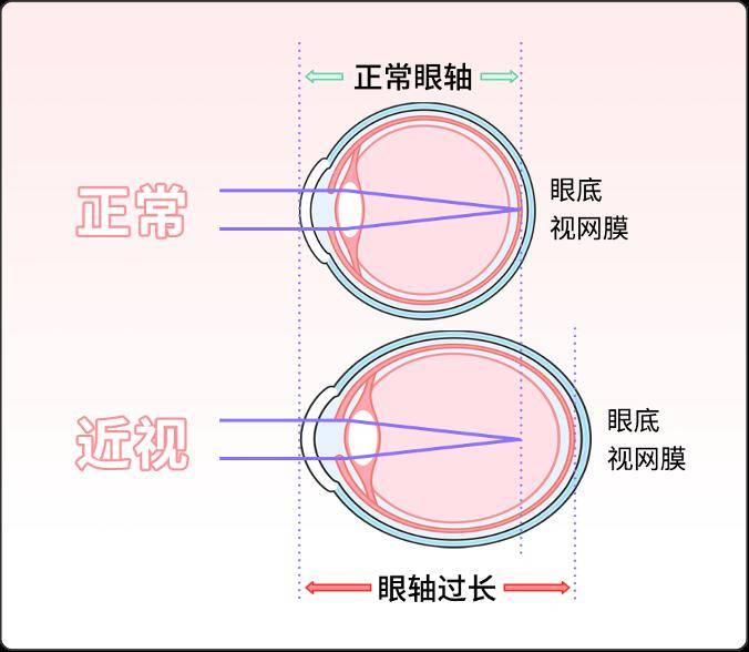 前面我們說過了,眼軸過長是近視的原因之一.