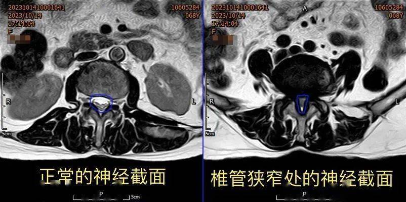 腰间盘突出ct图片