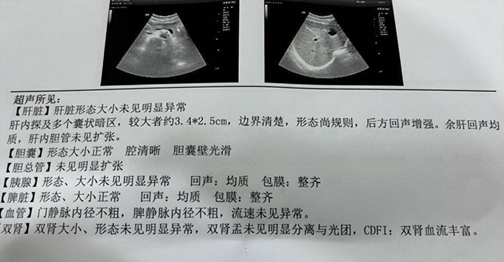 肝右叶囊肿图片