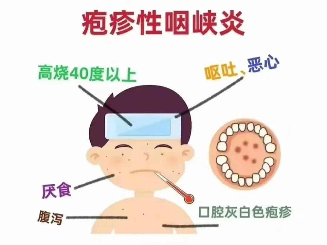 定义疱疹性咽峡炎是由肠道病毒引起的疾病.