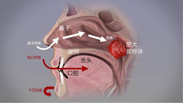 经常张口呼吸会变丑,用"闭嘴贴"?_影响_问题_面部