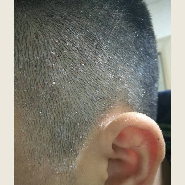 头皮_问题_头发