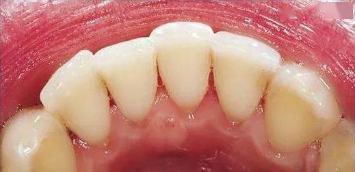 360度溶解陈年牙垢,比洗牙还干净10086倍!_牙齿_牙膏_口腔