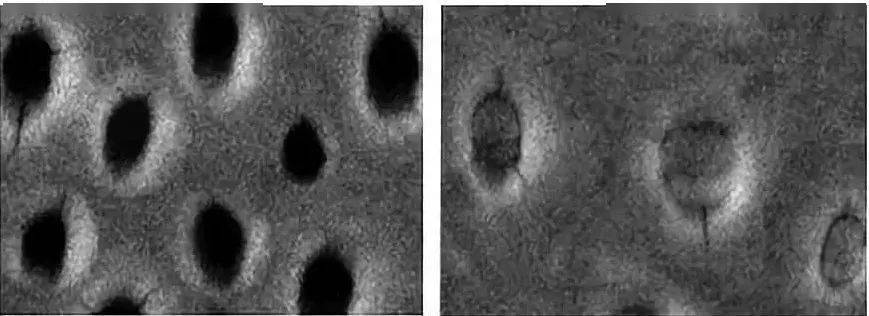 牙本质小管暴露图片