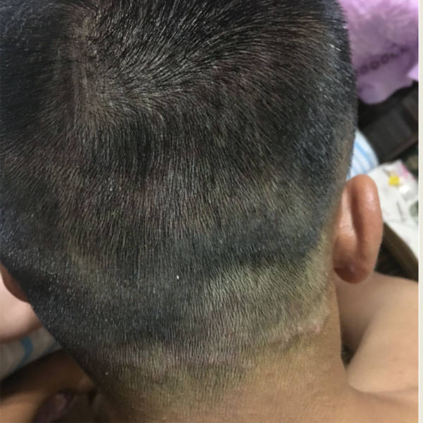 头皮屑_问题_产品