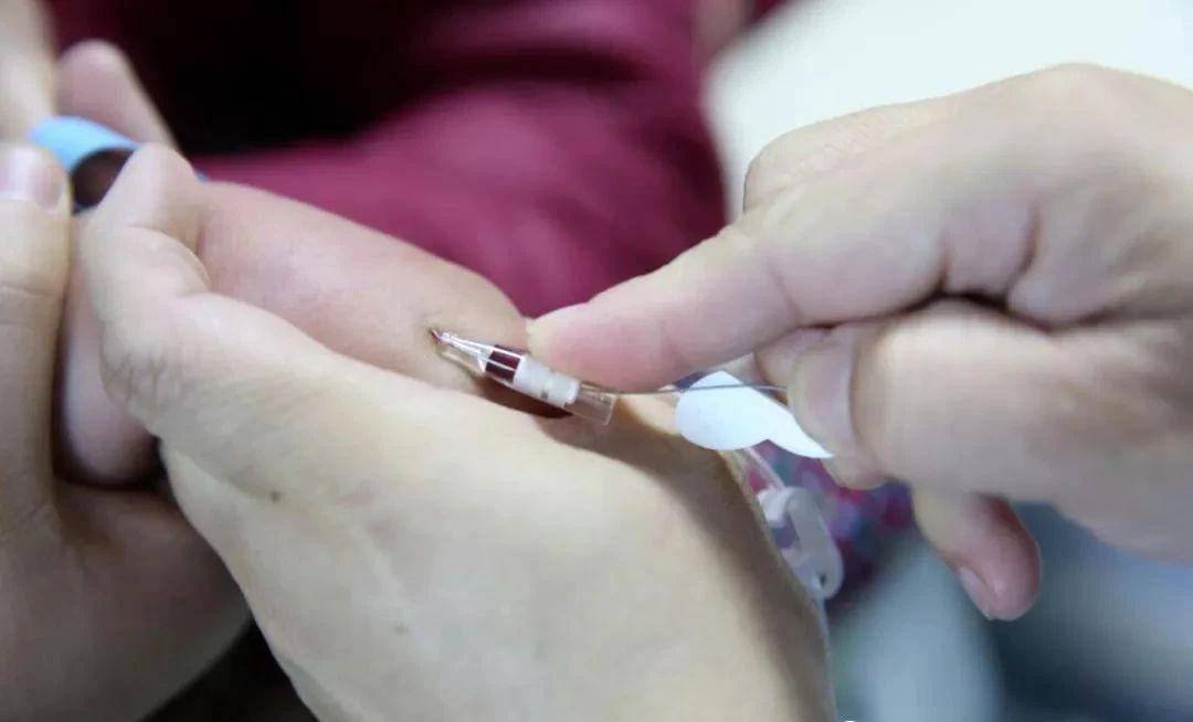 单手退针,这个操作你会吗?学会你就无敌了!_血管_患者_套管