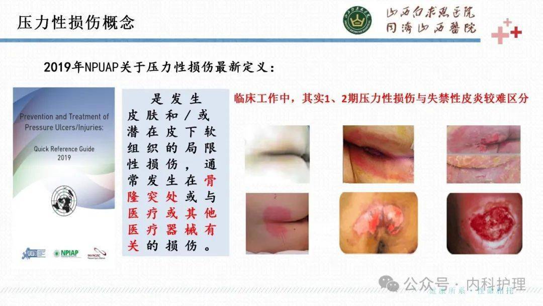 【ppt】成人失禁相关性皮炎的识别与护理_患者_治疗_临床