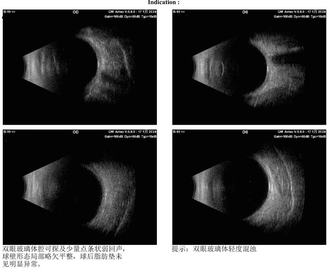 脉络膜脱离超声图图片