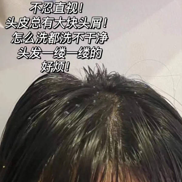 问题_去屑_头发