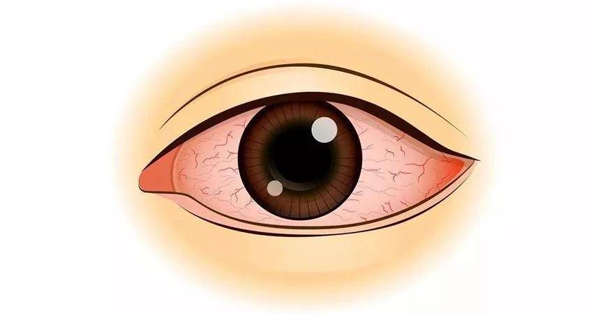 【健康科普】学校高发红眼病!看一眼就传染?预防中招看这里