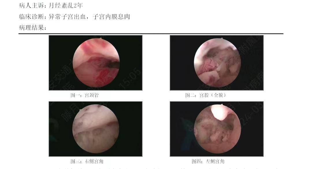 宫腔镜病例分享之